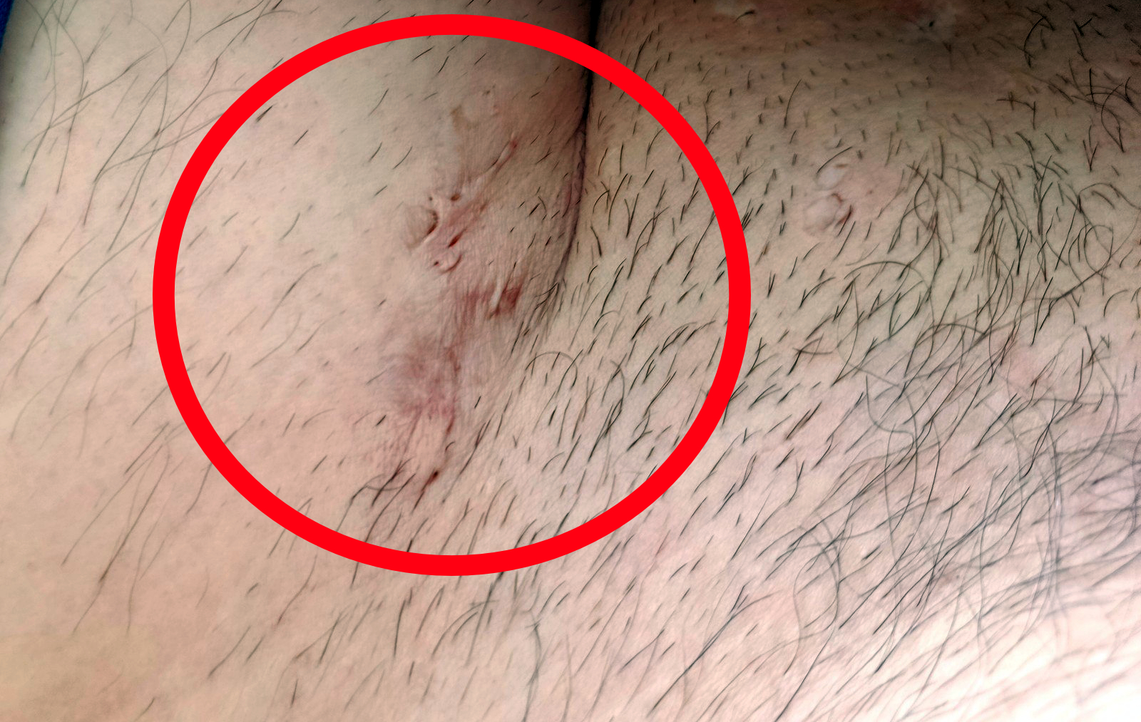 Kette aus mehreren Narbenknoten entlang der Leistenfalte — abgeheilter Fistelgang, typisches Hurley II Muster