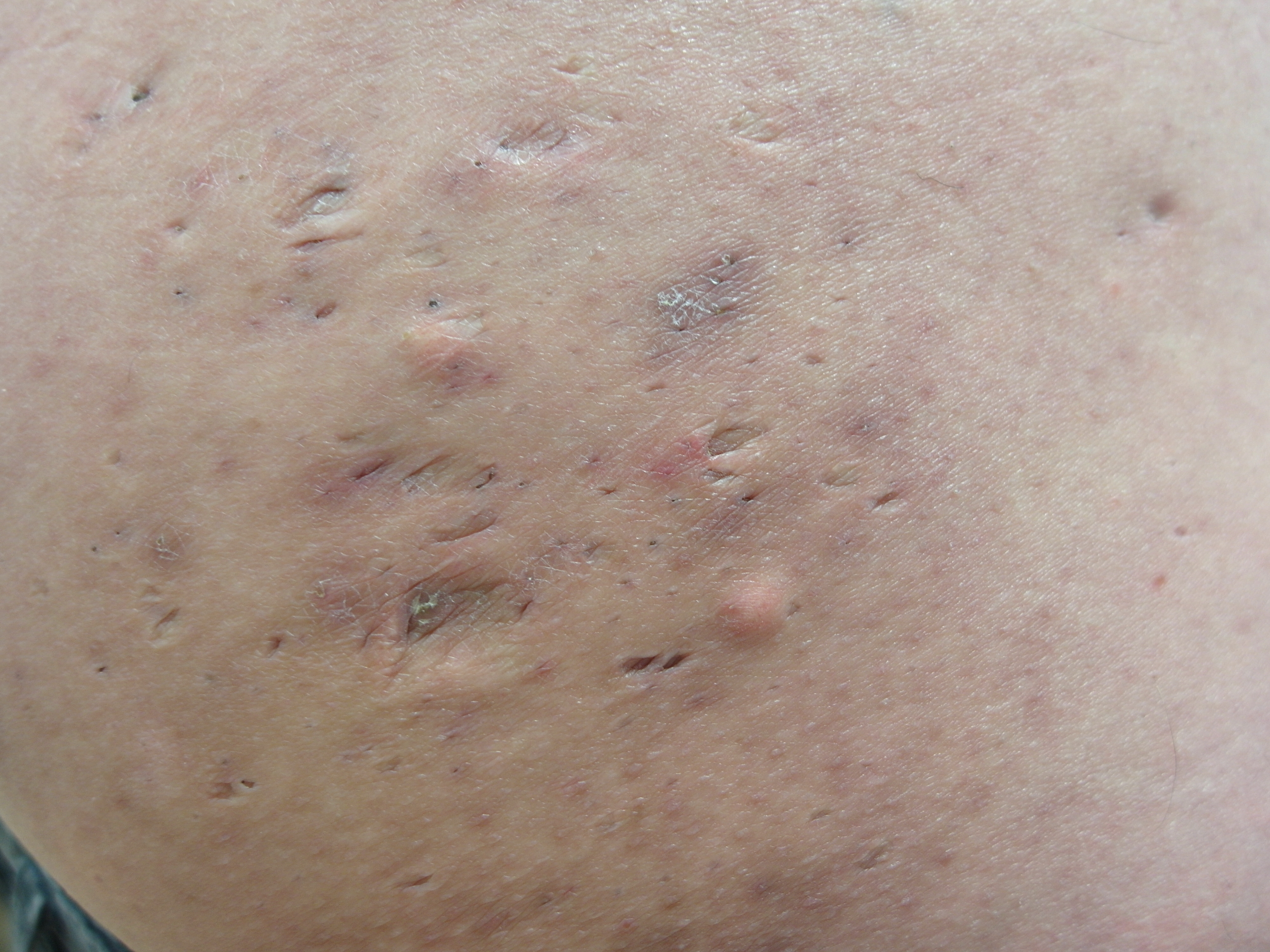 Acne inversa mit Abszess, Hurley Stadium II — Referenzfoto aus dem WIKIDERM-Bildarchiv