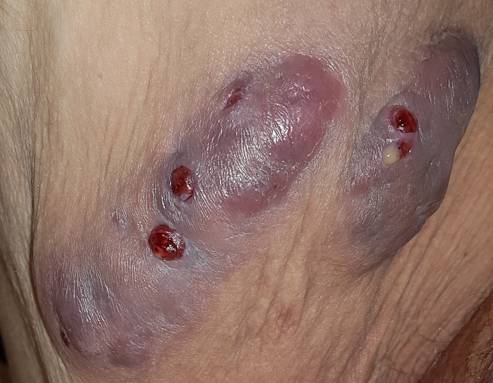 Hidradenitis suppurativa Hurley Stadium III — ausgedehnte flaechige Beteiligung mit dichtem Fistelnetzwerk und Vernarbung
